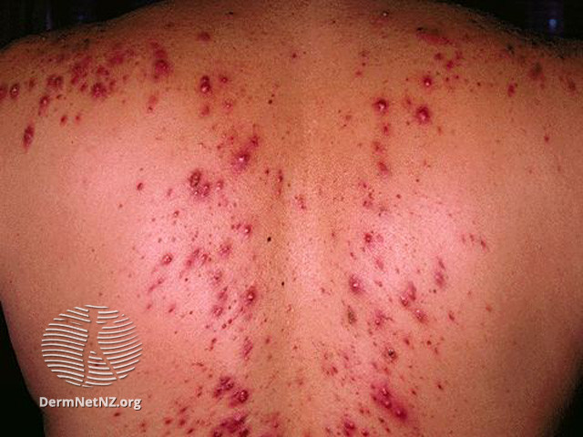 File:Acne affecting the back images (DermNet NZ acne-acne-back-196).jpg