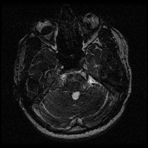 Acoustic schwannoma (Radiopaedia 33045-34060 Axial T2 45).png