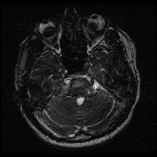 File:Acoustic schwannoma (Radiopaedia 33045-34060 Axial T2 47).png