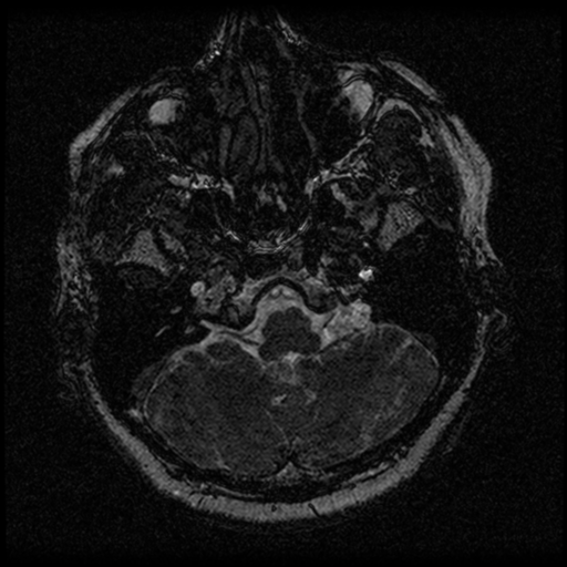 Acoustic schwannoma (Radiopaedia 33045-34060 Axial T2 8).png