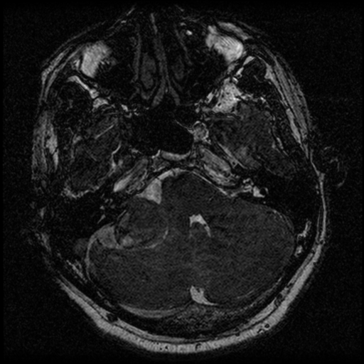 File:Acoustic schwannoma (Radiopaedia 39170-41387 Axial FIESTA 63).png