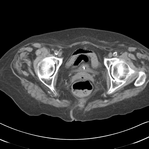 Active bleeding from duodenal ulcer with embolization (Radiopaedia 34216-35481 Axial non-contrast 64).png