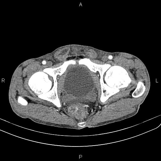 Active crohn disease (Radiopaedia 87133-103397 Axial C+ arterial phase 99).jpg