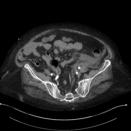 Active renal extravasation with large subcapsular and retroperitoneal hemorrhage (Radiopaedia 60975-68796 Axial C+ arterial phase 145).jpg