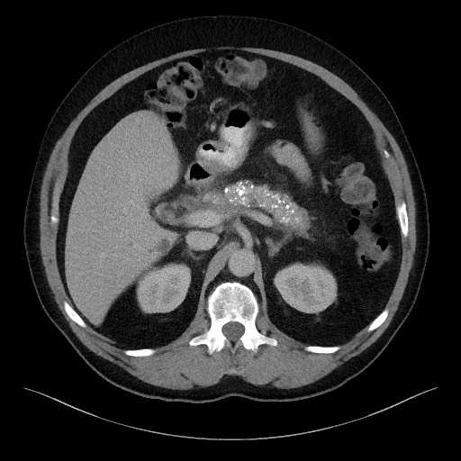 Acute-on-chronic pancreatitis (Radiopaedia 67286-76656 Axial C+ portal venous phase 25).jpg