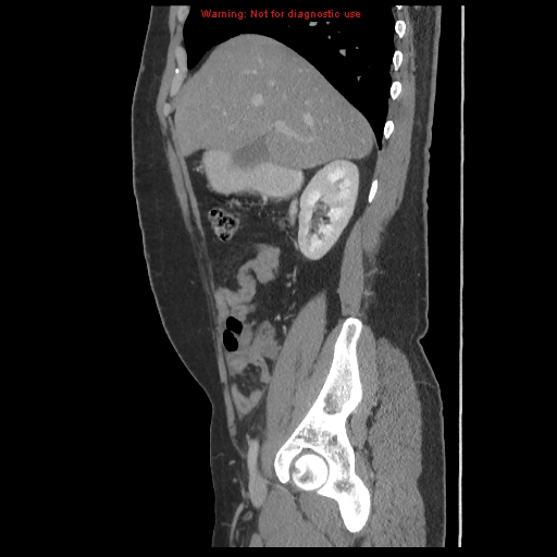 File:Acute appendicitis (Radiopaedia 10498-10973 Sagittal C+ portal venous phase 5).jpg