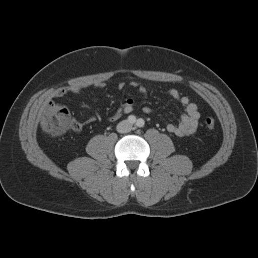 Acute appendicitis (Radiopaedia 48511-53463 Axial C+ portal venous phase 59).jpg