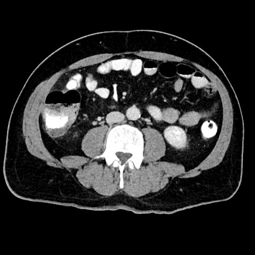 Acute appendicitis (Radiopaedia 77016-88960 Axial C+ portal venous phase 79).jpg