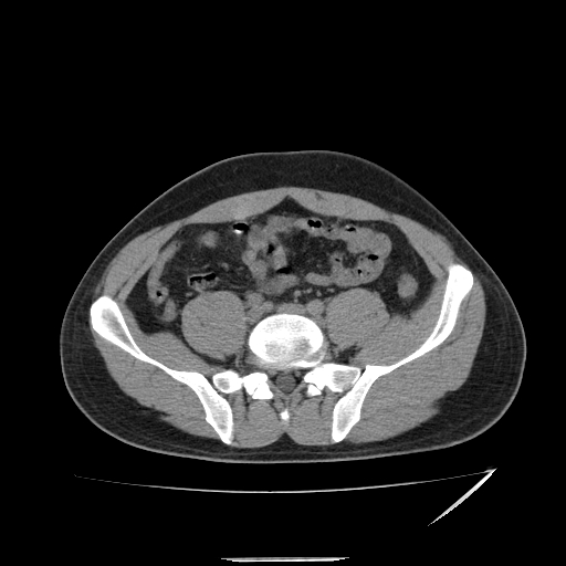 File:Acute appendicitis (Radiopaedia 81320-95015 A 2).jpg