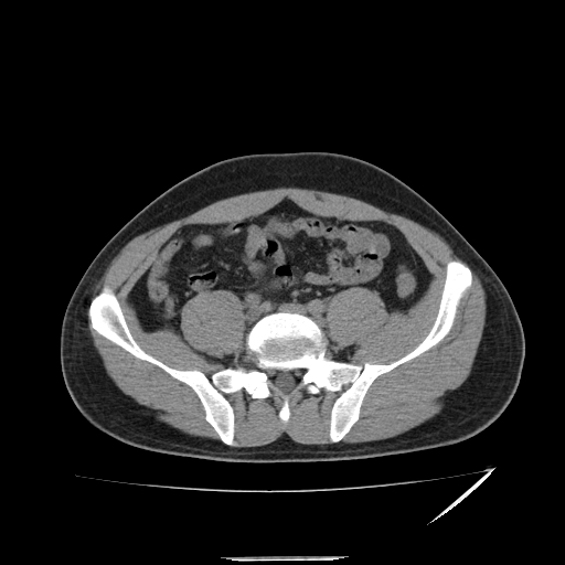 File:Acute appendicitis (Radiopaedia 81320-95015 A 4).jpg