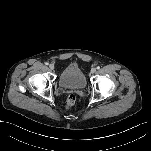 File:Acute appendicitis - large appendicoliths (Radiopaedia 61805-69820 Axial C+ portal venous phase 122).jpg