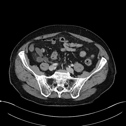 File:Acute appendicitis - large appendicoliths (Radiopaedia 61805-69820 Axial C+ portal venous phase 94).jpg