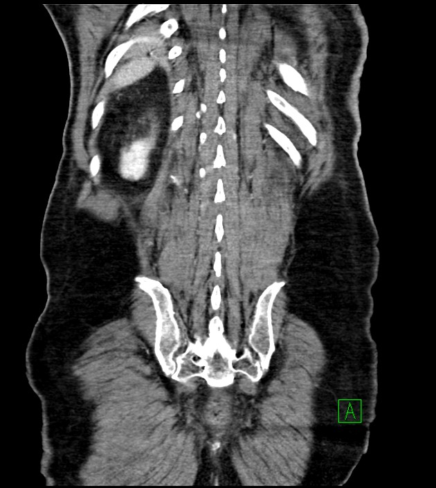 Acute arterial mesenteric ischemia (Radiopaedia 78238-90828 Coronal C+ portal venous phase 77).jpg