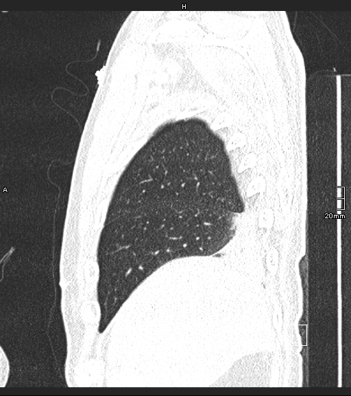 Acute aspiration pneumonitis (Radiopaedia 55642-62166 Sagittal lung window 133).jpg