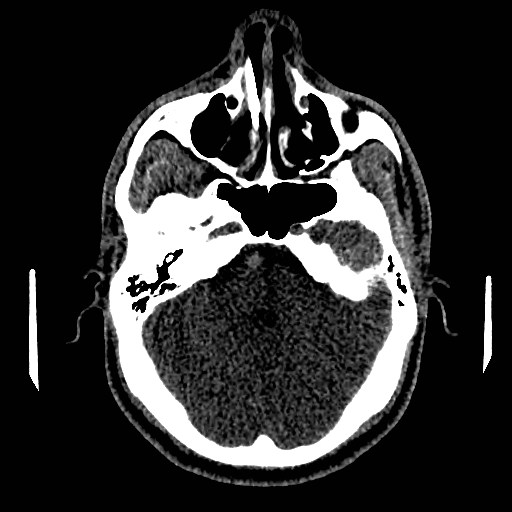 Acute basilar artery occlusion (Radiopaedia 43582-46985 Axial non-contrast 60).jpg