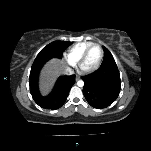 File:Acute bilateral pyelonephritis (Radiopaedia 37146-38881 Axial C+ arterial phase 3).jpg