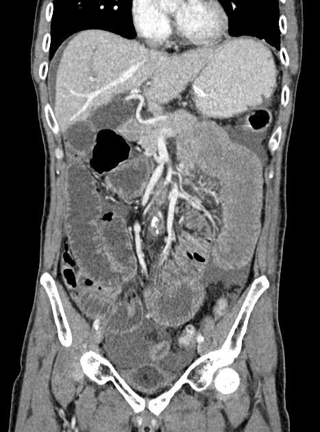 Acute bowel ischemia (Radiopaedia 87695-104114 Coronal C+ portal venous phase 176).jpg