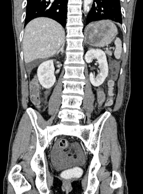 Acute bowel ischemia (Radiopaedia 87695-104114 Coronal C+ portal venous phase 259).jpg