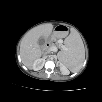 Acute calculous cholecystitis in patient with osteopetrosis (Radiopaedia 77871-90159 Axial C+ portal venous phase 35).jpg