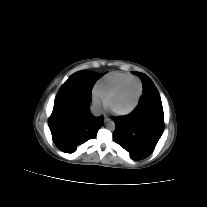 File:Acute calculous cholecystitis in patient with osteopetrosis (Radiopaedia 77871-90159 Axial non-contrast 12).jpg