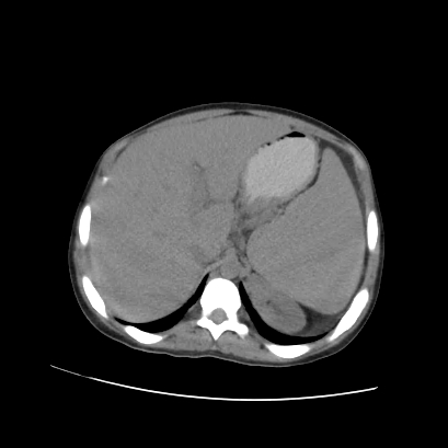File:Acute calculous cholecystitis in patient with osteopetrosis (Radiopaedia 77871-90159 Axial non-contrast 24).jpg