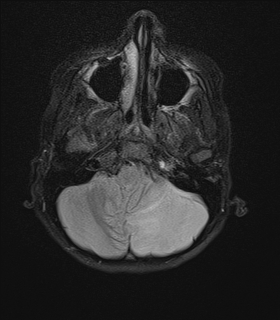 File:Acute cerebellar ataxia (Radiopaedia 61487-69446 Axial FLAIR 3).jpg