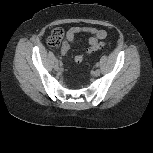 Acute cholecystitis and ureteric colic (Radiopaedia 42330-45444 Axial prone 86).jpg