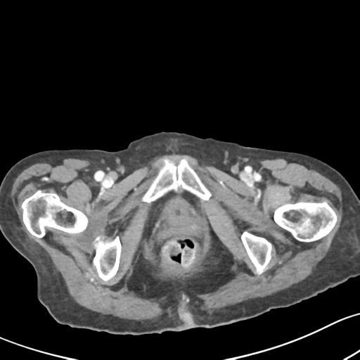 Acute cholecystitis with contained perforation (Radiopaedia 47328-51907 Axial C+ portal venous phase 74).png