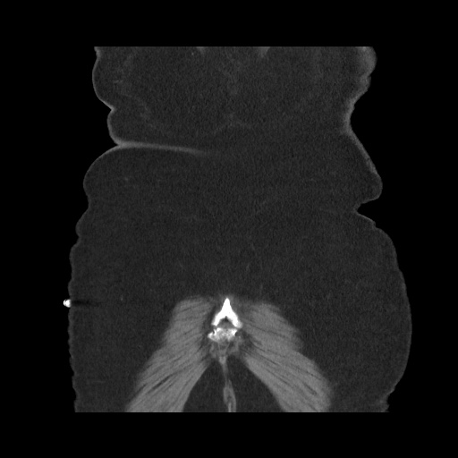 Acute cholecystitis with tensile fundus sign (Radiopaedia 71394-81723 Coronal non-contrast 115).jpg
