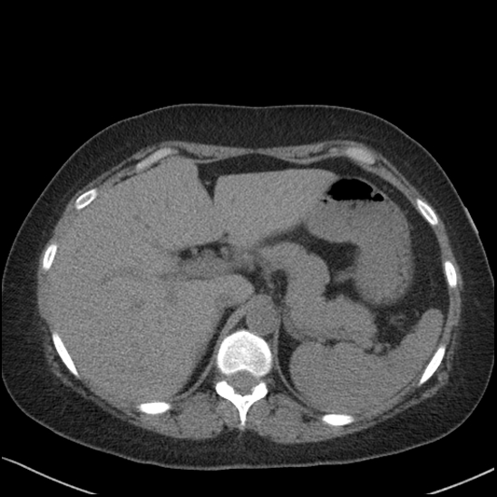 Acute colonic hemorrhage in ulcerative colitis (Radiopaedia 77415-89538 Axial non-contrast 31).jpg