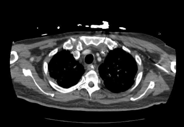 File:Acute cor pulmonale (ultrasound) (Radiopaedia 83508-98818 Axial 158).jpg