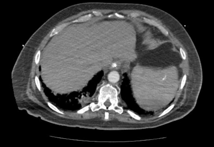 Acute cor pulmonale (ultrasound) (Radiopaedia 83508-98818 Axial C+ CTPA 70).jpg