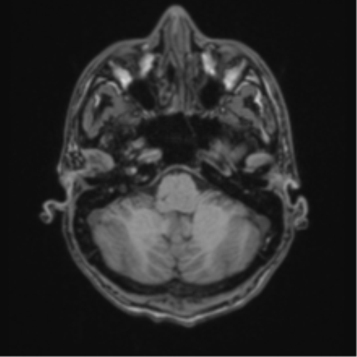 Acute disseminated encephalomyelitis (ADEM) (Radiopaedia 65319-74349 Axial T1 10).png