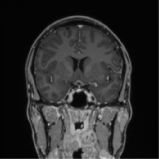 File:Acute disseminated encephalomyelitis (ADEM) (Radiopaedia 65319-74349 Coronal T1 C+ 32).png