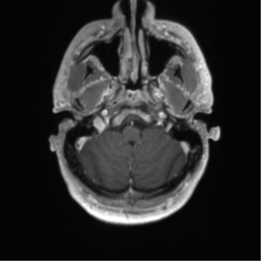 Acute disseminated encephalomyelitis (ADEM) (Radiopaedia 65319-74350 Axial T1 C+ 4).png