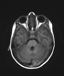 File:Acute disseminating encephalomyelitis with bilateral optic neuritis (Radiopaedia 79676-92886 Axial T1 8).jpg