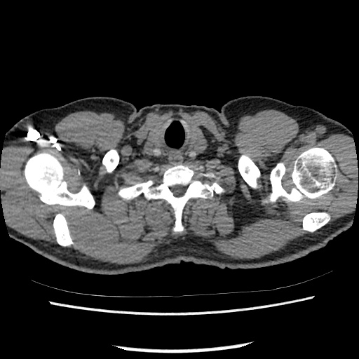 Acute epicardial fat necrosis (Radiopaedia 42327-45440 Axial C+ CTPA 8).jpg
