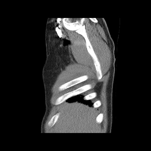 Acute epicardial fat necrosis (Radiopaedia 42327-45440 Sagittal C+ CTPA 10).jpg