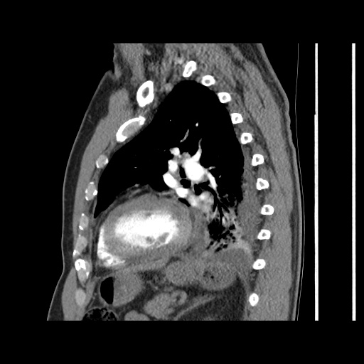 Acute epicardial fat necrosis (Radiopaedia 42327-45440 Sagittal C+ CTPA 47).jpg
