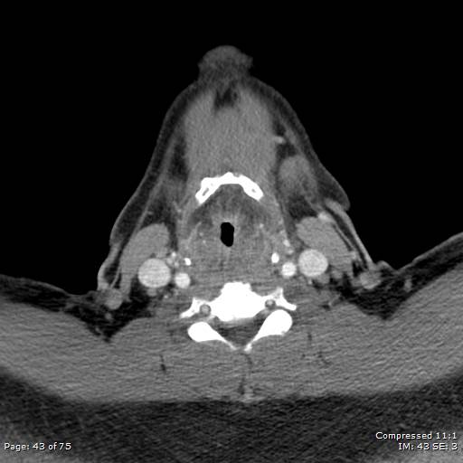 Acute epiglottitis (Radiopaedia 54375-60590 Axial C+ arterial phase 43).jpg