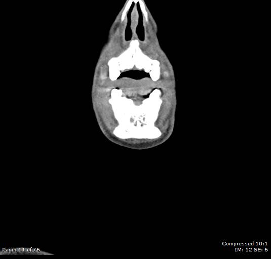 Acute epiglottitis (Radiopaedia 54375-60590 Coronal C+ arterial phase 11).jpg