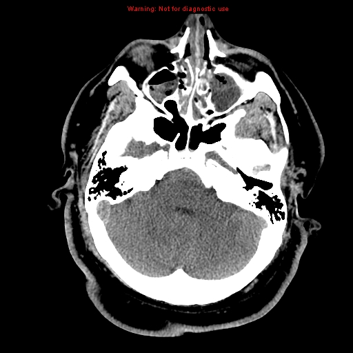 Acute hemorrhagic leukoencephalitis (Radiopaedia 14076-13920 Axial non-contrast 10).jpg