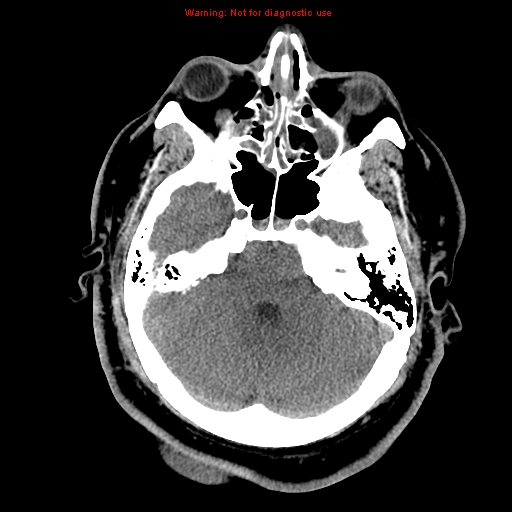 Acute hemorrhagic leukoencephalitis (Radiopaedia 14076-13920 Axial non-contrast 12).jpg