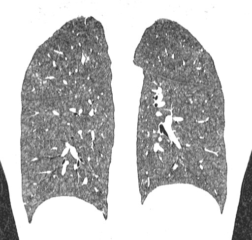 Acute hypersensitivity pneumonitis (Radiopaedia 85293-100870 Coronal lung window 93).jpg