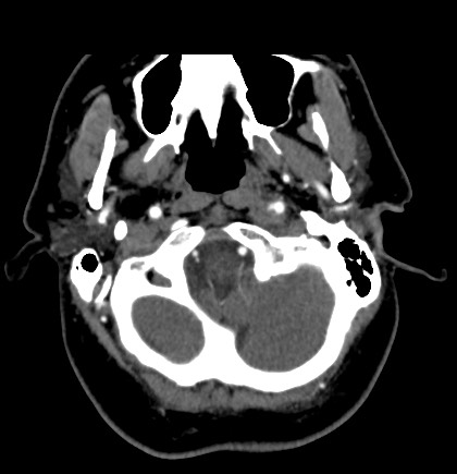 File:Acute internal carotid artery dissection (Radiopaedia 53541-59630 Axial C+ arterial phase 7).jpg