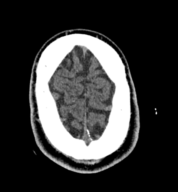 Acute ischemic stroke - posterior circulation territory (Radiopaedia 77670-89881 non-contrast 83).jpg