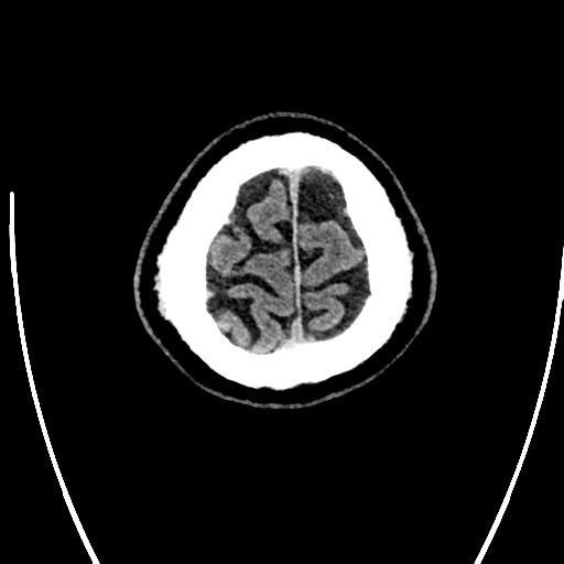Acute left middle cerebral artery territory ischemic stroke (Radiopaedia 35688-37223 Axial non-contrast 81).png