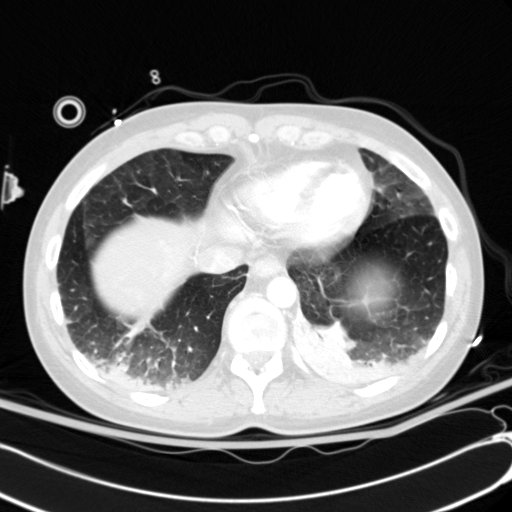 Acute myocardial infarction in CT (Radiopaedia 39947-42415 Axial lung window 106).jpg