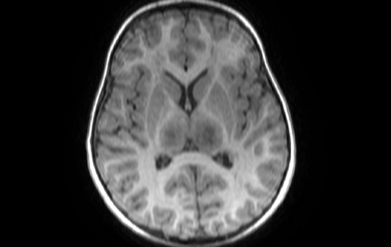 File:Acute necrotizing encephalitis of childhood (Radiopaedia 67356-76737 Axial T1 44).jpg