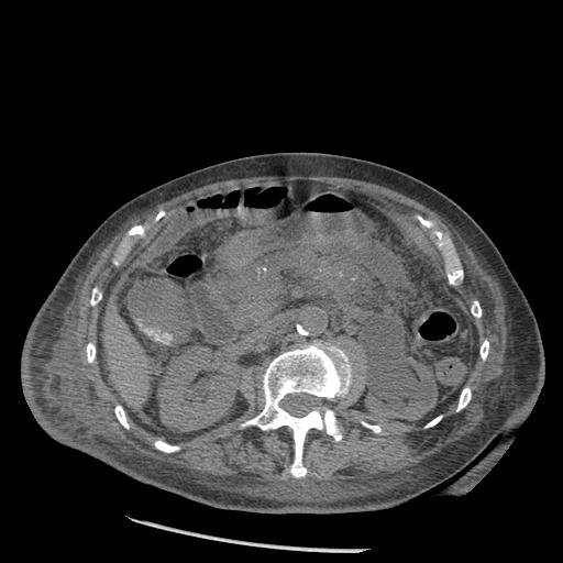 Acute on chronic pancreatitis (Radiopaedia 13233-13244 Axial non-contrast 41).jpg